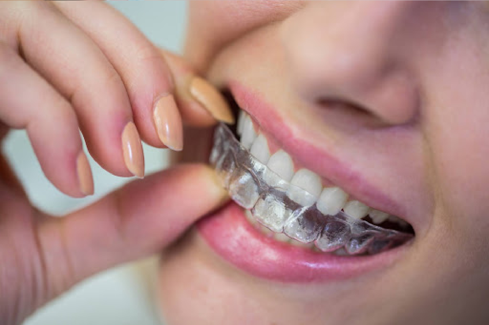 Clear Aligners in Brookefield, Bangalore