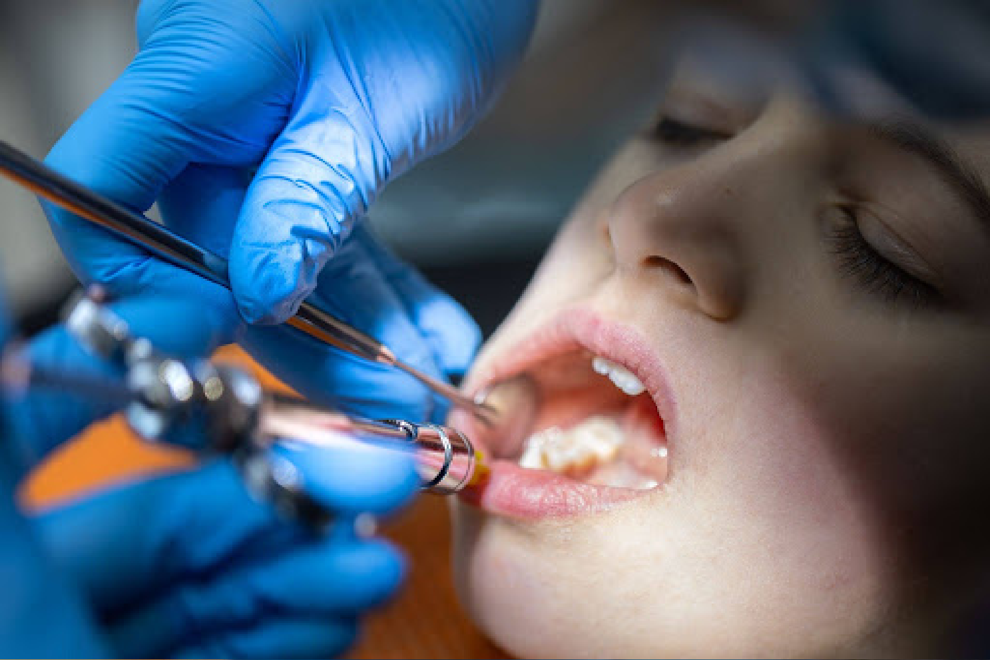 Root Canal Treatment in Brookefield, Bangalore